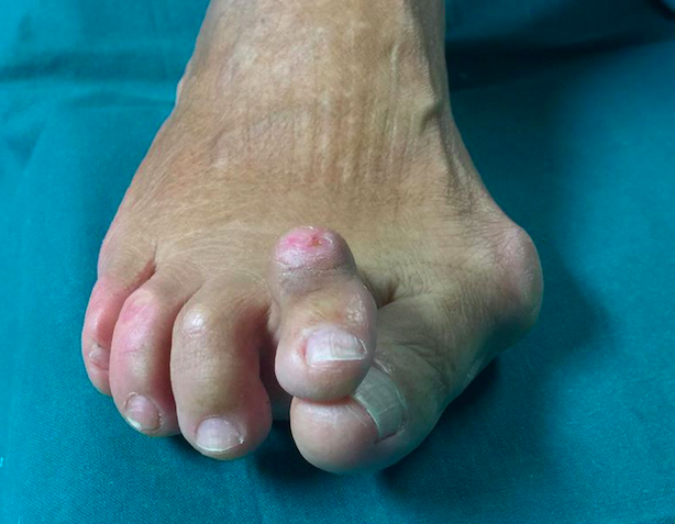 Alluce valgo con 2° dito a martello in cross-over