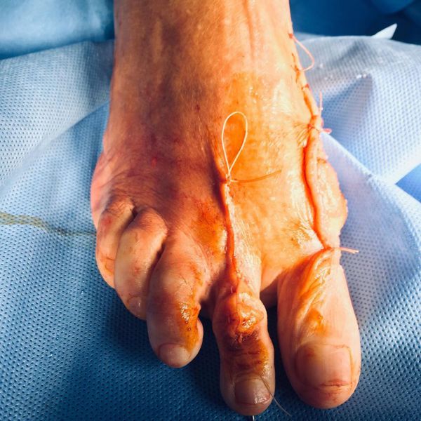 Post intervento (in sala operatoria)